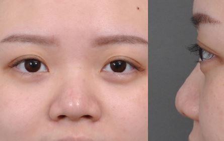 塌鼻子,隆鼻,隆鼻手術,台北隆鼻,新竹隆鼻