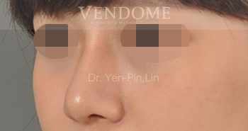 韓式隆鼻,蒜頭鼻,隆鼻,隆鼻手術,台北隆鼻手術,新竹隆鼻手術,台南隆鼻手術