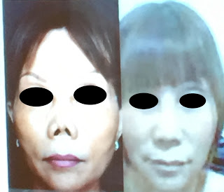 朝天鼻,蒜頭鼻,韓式隆鼻,隆鼻手術