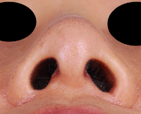 朝天鼻,蒜頭鼻,韓式隆鼻,隆鼻手術