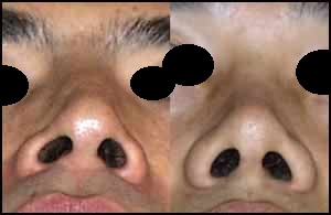 朝天鼻,蒜頭鼻,韓式隆鼻,隆鼻手術
